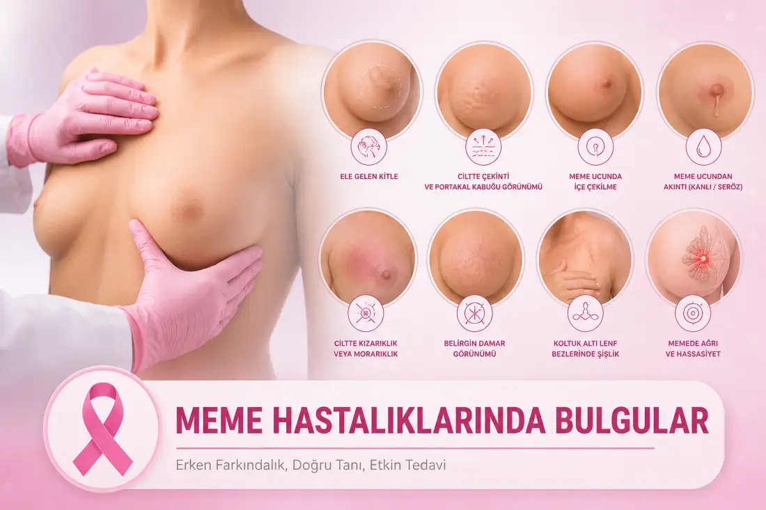 Meme Hastalıklarında Bulgular
